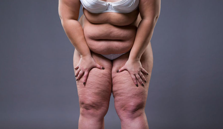 Lipedema x Obesidade: Entenda as Diferenças e o Diagnóstico Diferencial para o Cuidado Integral