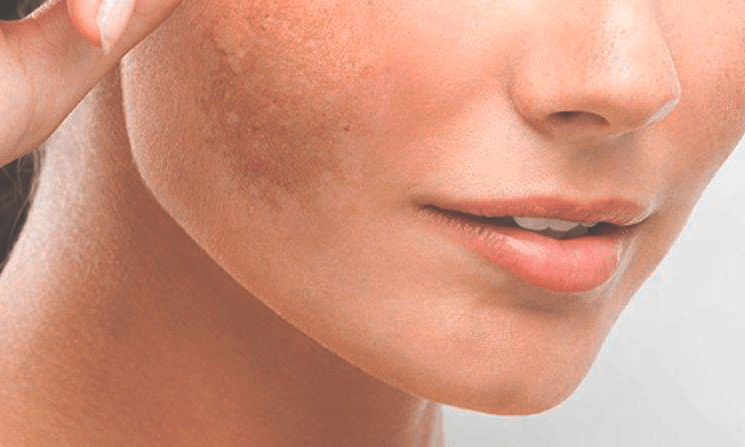 Melasma: o que é e como tratar